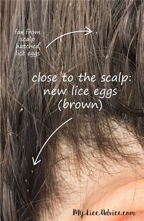 Pictures of What Lice Eggs (Nits) Look Like in Hair: 9 Tips to Spot Them