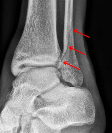 - Weber B Fracture Treatment Australia