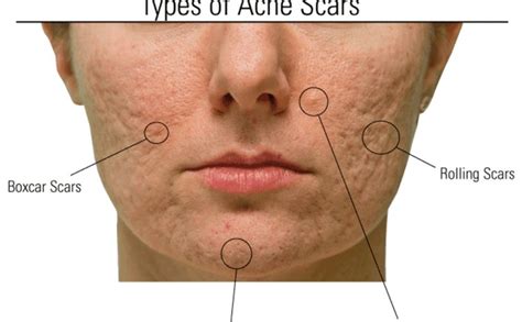 Focus on Different Types of Acne Scars - MedLaserUSA