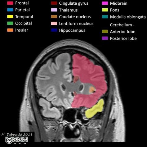 Brain lobes - annotated MRI | Radiology Case | Radiopaedia.org ...