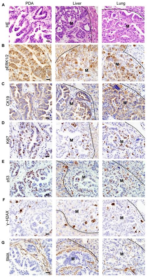 (A) Histology of a primary pancreatic adenocarcinoma and metastases to ...