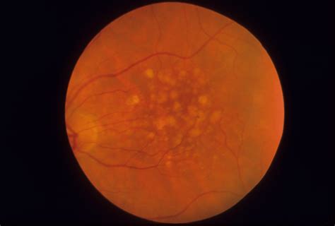 Doyne Honeycomb Macular Dystrophy | Hereditary Ocular Diseases