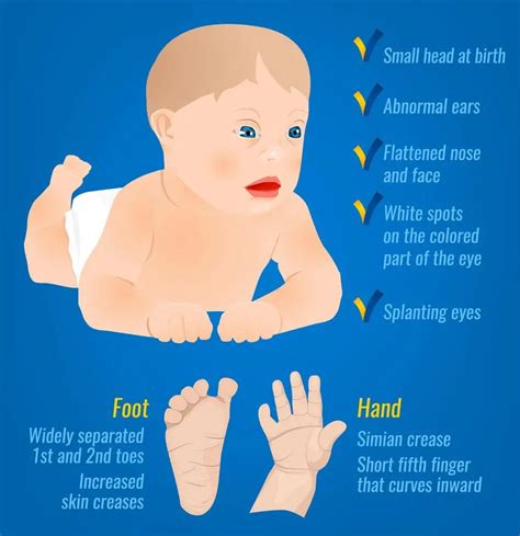 Symptoms Down Syndrome Poster Abnormal Ears: