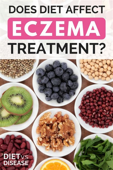 Does Diet Affect Eczema Treatment? | Diet vs Disease