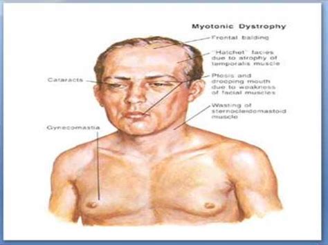 Myotonic dystrophy - YouTube