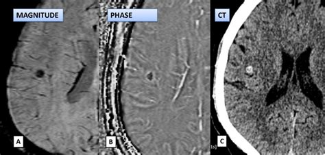 Calcified granuloma appearing dark on both magnitude and phase image in ...