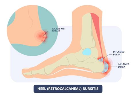 Achilles Bursitis - Rehab 49