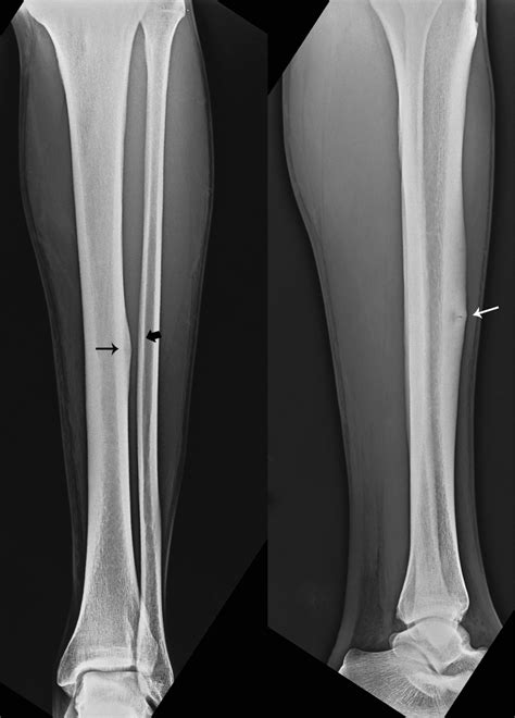 [DIAGRAM] Diagram Of Tibia Stress Fracture - MYDIAGRAM.ONLINE