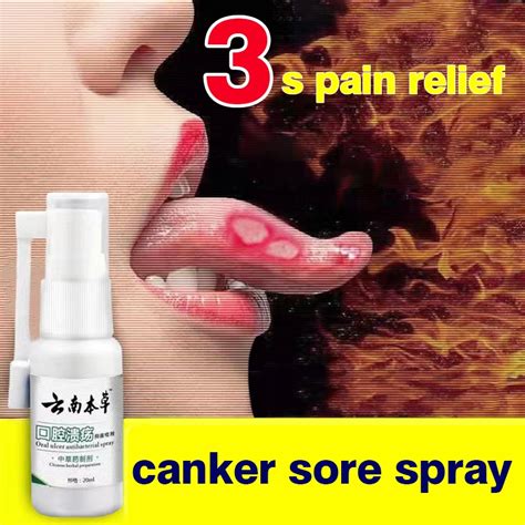 Canker Mouth Sore Solution Mouth Ulcer Treatment Spray gamot sa singaw ...