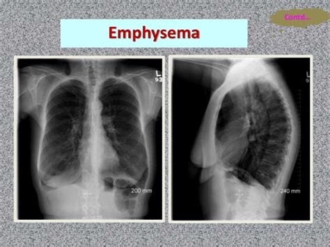 Emphysema Vs Normal Chest X Ray