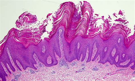 Epidermal Nevus Histology