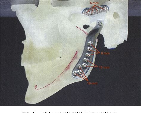 Figure 1 from Secondary Treatment of Malocclusion/Malunion Secondary to ...