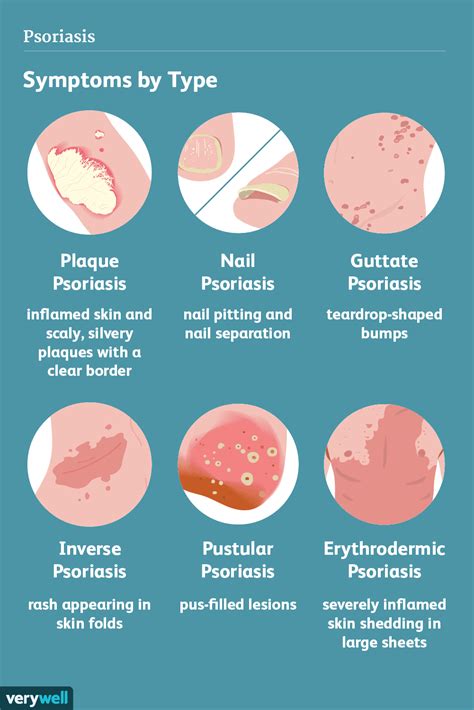 Psoriasis: Symptoms and Complications