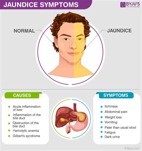 Explore Jaundice Symptoms, Causes And Types