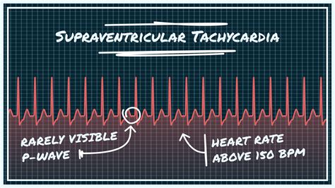 Supraventricular Tachycardia Vs Ventricular Tachycardia