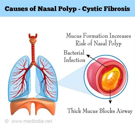 Nasal Polyp Causes Symptoms Treatment Nasal Polyp