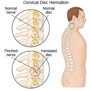 Cervical Disc Herniation - What You Need to Know