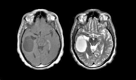 Gadolinium-Based Contrast Agents (GBCAs) - StoryMD