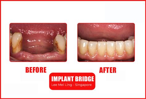 IMPLANT BRIDGE AT SAI GON IMPLANT DENTAL