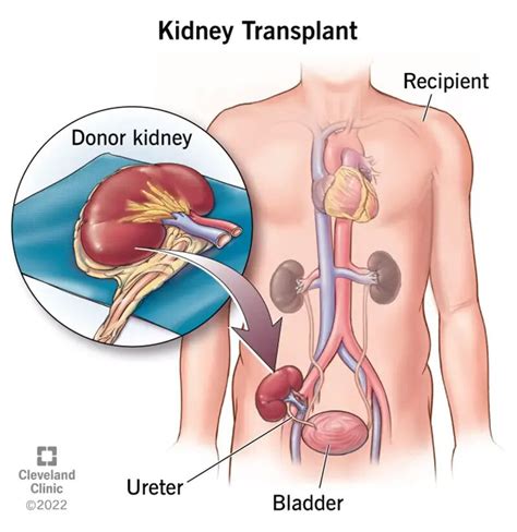 Kidney Transplant: Surgery, Purpose, Procedure & Recovery