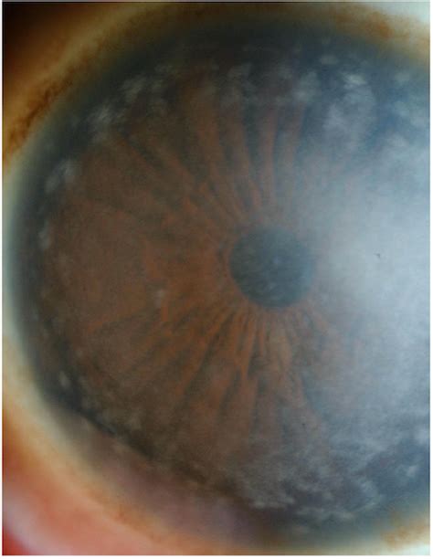 Macular corneal dystrophy: for professionals - Gene Vision