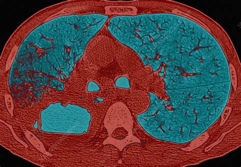 Lung abscess, CT scan - Stock Image - C018/7141 - Science Photo Library