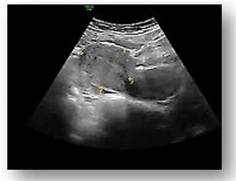 Ruptured Ectopic Pregnancy Ultrasound