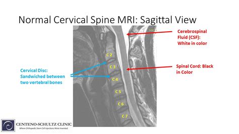 Normal Vs Abnormal Mri Cervical Spine | Hot Sex Picture