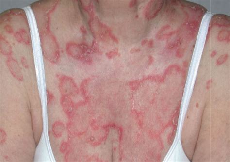 ACD A-Z of Skin - Cutaneous Lupus Erythematosus