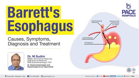 Barrett's Esophagus – Symptoms, Causes, Types And, 51% OFF