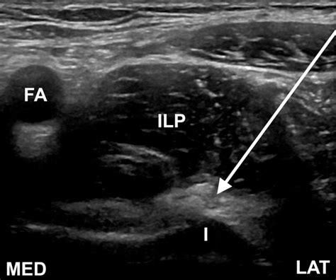 Iliopsoas Bursitis Ultrasound