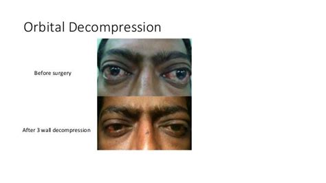 Graves Orbitopathy