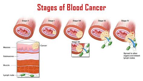 Stages Of Cancer