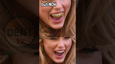 Taylor Swift Before And After Veneers