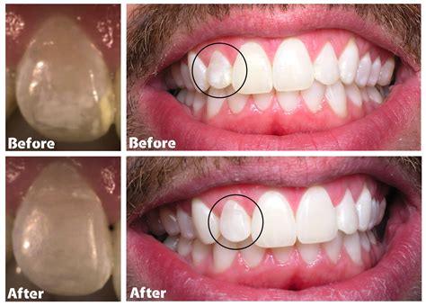 Are White Spots On Teeth Cavities - TeethWalls