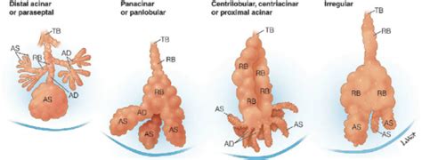 Emphysema - Physiopedia