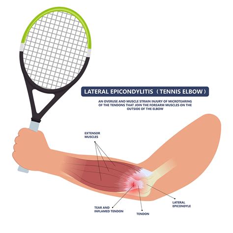 Tennis Elbow (Lateral Epicondylitis): Causes, Symptoms, Treatment