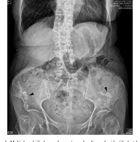 Figure 1 from A woman with multiple calcified granulomas | Semantic Scholar