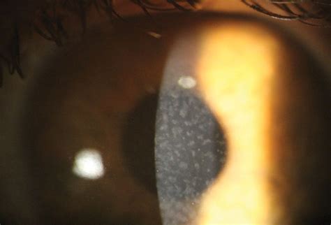 Macular Dystrophy Corneal