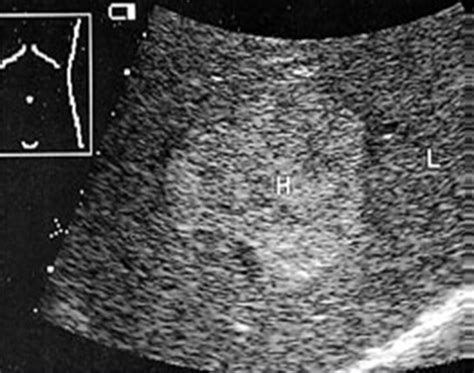 ULTRASOUND FINDINGS OF LIVER HEMANGIOMA - Wroc?awski Informator ...