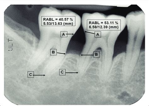 Proximal digital radiographic alveolar bone loss (DRABL) was defined as ...