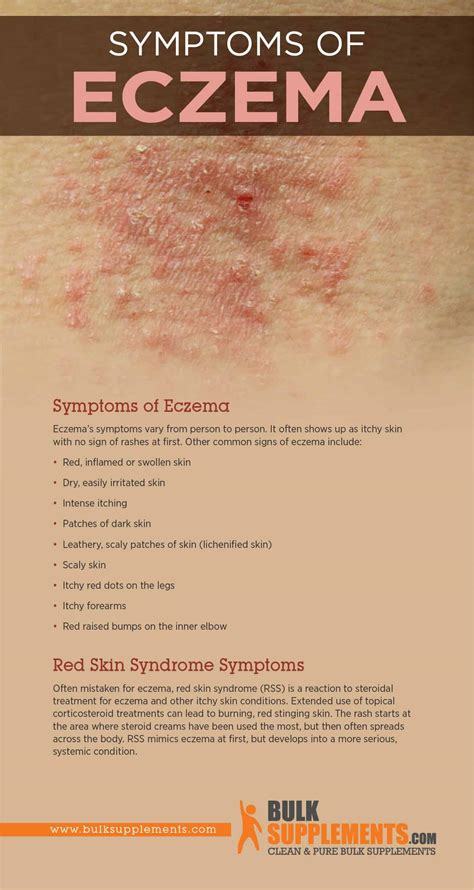 Eczema: Characteristics, Causes & Treatment