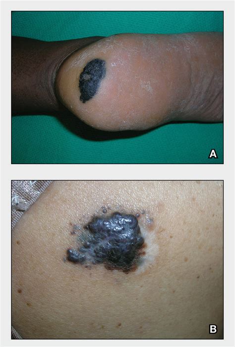 Acral Lentiginous Melanoma Metastatic Melanoma