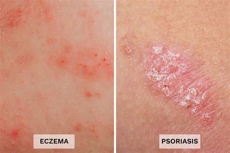 Eczema vs. Psoriasis: 13 Differences You Should Know | The Healthy