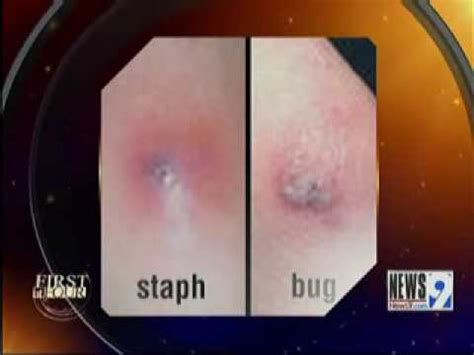 Bug Bites vs. Staph Infections - YouTube