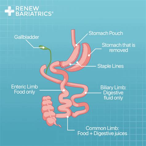 Biliopancreatic Diversion With Duodenal Switch | Renew Bariatrics