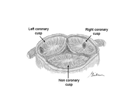 Aortic sinus - wikidoc