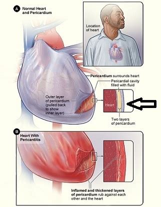 Pericardial Drain Nursing Management - Best Drain Photos Primagem.Org