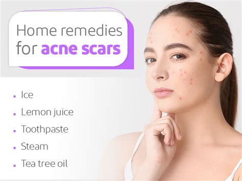 Home Remedies for Acne Scars