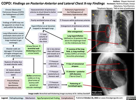 COPD: Findings on Posterior-Anterior and Lateral Chest X-ray Findings ...